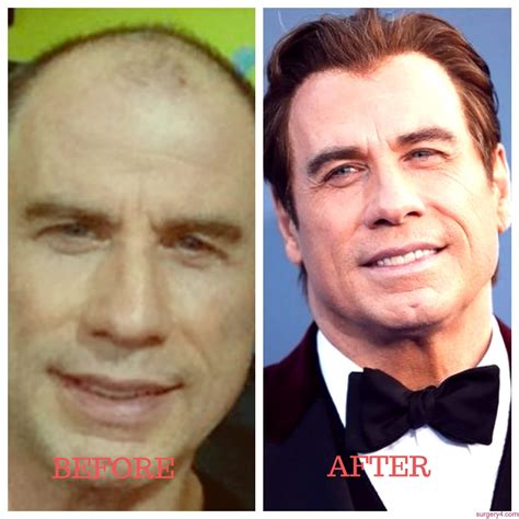 john travolta face lift|John Travolta Plastic Surgery Photos [Before & After]